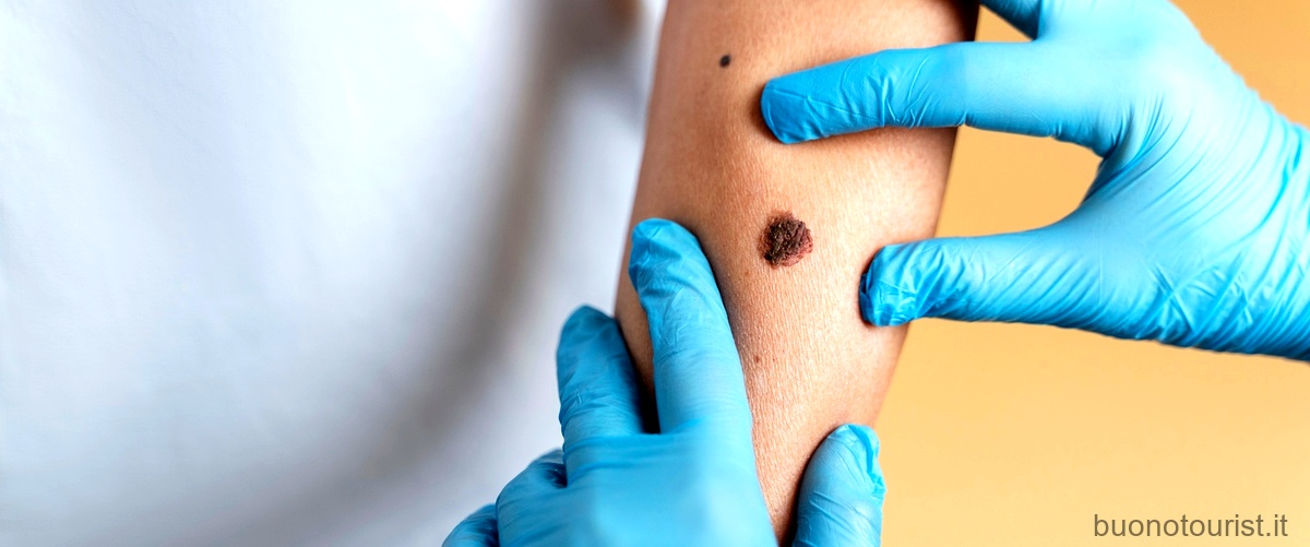 Cosa sono i ticks sulla pelle: tutto ciò che devi sapere