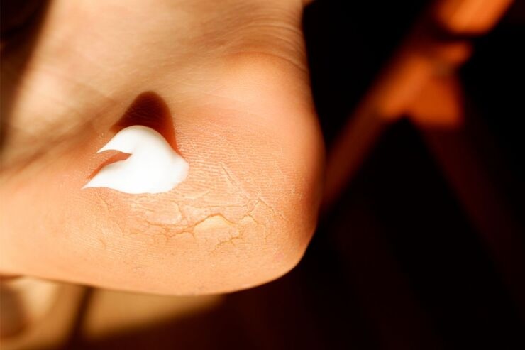 Noce di crema su tallone screpolato 
